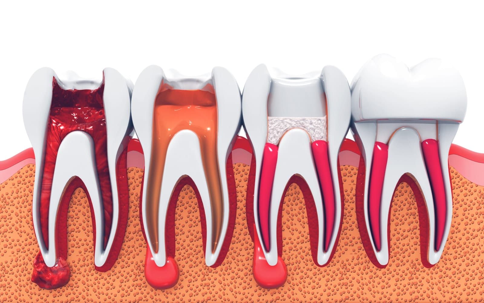 Root Canal Treatment Steps